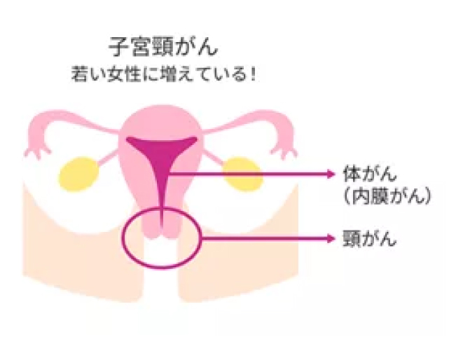 子宮頸がん